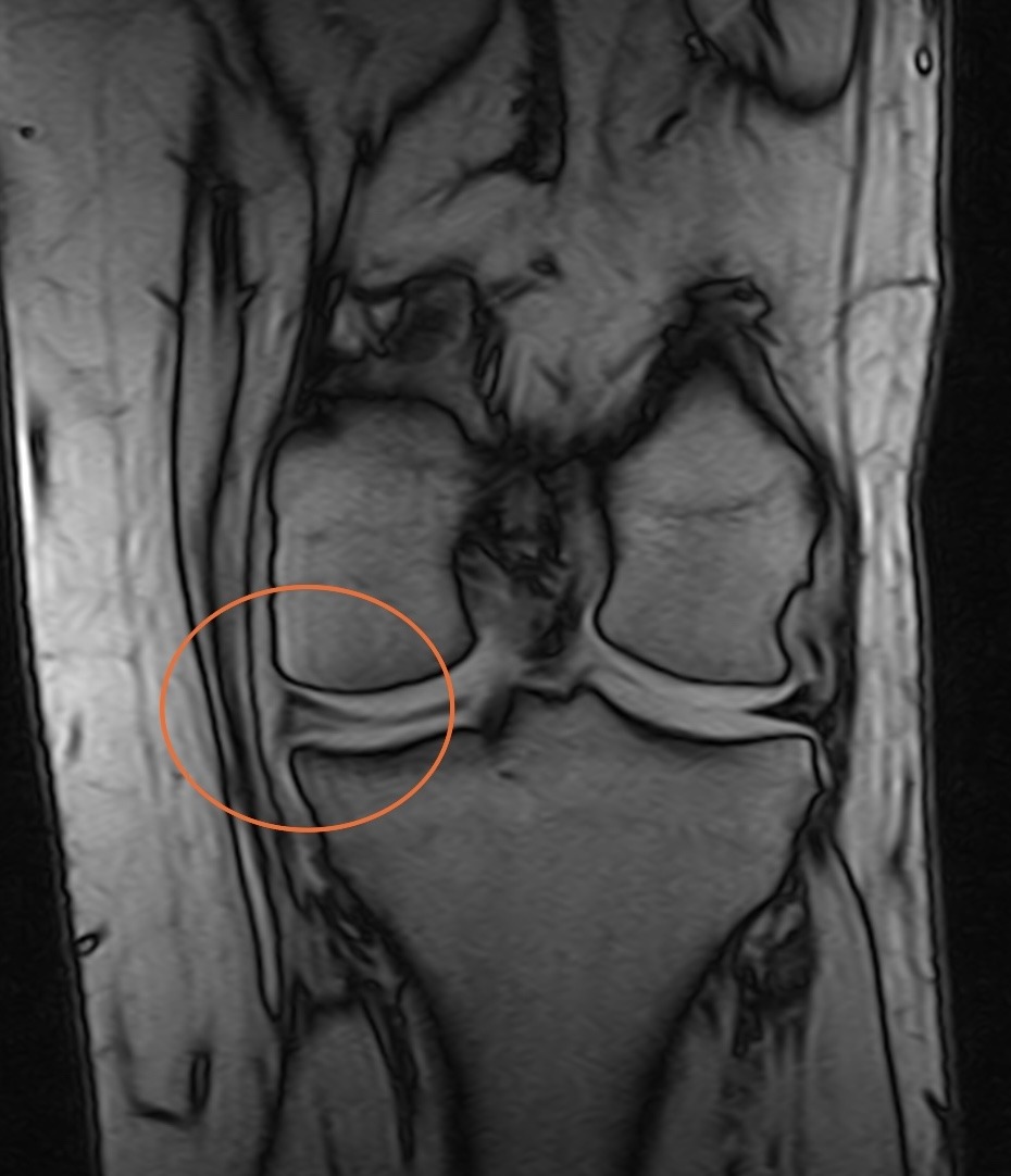 Risonanza magnetica del ginocchio con lesione del menisco evidenziata